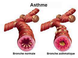 Plante pour guérir l'asthme naturellement