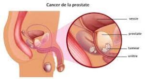 Le cancer de la prostate remède naturel 
